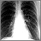 Coccidioidomycosis - chest X-ray Coccidioidomycosis - chest X-ray