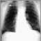 Pulmonary nodule - front view chest x-ray Pulmonary nodule - front view chest x-ray
