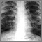 Sarcoid, stage II - chest X-ray Sarcoid, stage II - chest X-ray