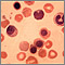 Erythroblastosis fetalis - photomicrograph Erythroblastosis fetalis - photomicrograph