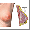 Breast infection Breast infection