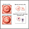 Cervical neoplasia Cervical neoplasia