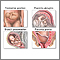 Cesarean section Cesarean section