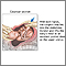 Cesarean section Cesarean section
