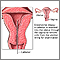 Endometrial biopsy Endometrial biopsy