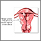Fibroid tumors Fibroid tumors