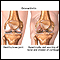 Osteoarthritis Osteoarthritis