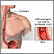 CMV esophagitis CMV esophagitis
