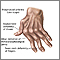 Rheumatoid arthritis Rheumatoid arthritis