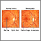 Diabetic retinopathy