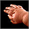 Polydactyly - an infant's hand Polydactyly - an infant's hand