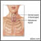 Retrosternal thyroid Retrosternal thyroid