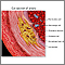 Enlarged view of atherosclerosis Enlarged view of atherosclerosis