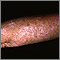 Actinic keratosis on the arm Actinic keratosis on the arm