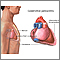 Constrictive pericarditis Constrictive pericarditis