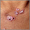 Lupus, discoid - view of lesions on the chest Lupus, discoid - view of lesions on the chest