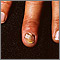 Nail infection - candidal Nail infection - candidal