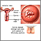 Cervical cancer Cervical cancer