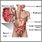 Crohn disease - affected areas Crohn disease - affected areas