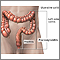 Ulcerative colitis Ulcerative colitis