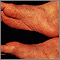 Reactive arthritis - view of the feet Reactive arthritis - view of the feet