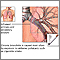Causes of chronic bronchitis Causes of chronic bronchitis