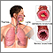 Asthmatic bronchiole and normal bronchiole Asthmatic bronchiole and normal bronchiole