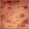 Acute monocytic leukemia - skin Acute monocytic leukemia - skin