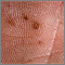 Basal cell nevus syndrome - close-up of palm Basal cell nevus syndrome - close-up of palm