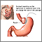 Adjustable gastric banding Adjustable gastric banding