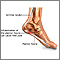 Plantar fasciitis Plantar fasciitis