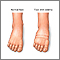 Foot swelling Foot swelling