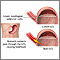 Gastroesophageal reflux disease Gastroesophageal reflux disease