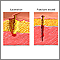 Laceration versus puncture wound Laceration versus puncture wound