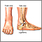 Ankle sprain - Series Ankle sprain - Series