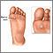 Plantar wart Plantar wart