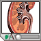 Kidney stones Kidney stones