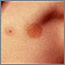 Urticaria pigmentosa in the armpit Urticaria pigmentosa in the armpit