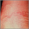 Cutaneous larva migrans Cutaneous larva migrans
