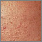 Blackheads (comedones) close-up Blackheads (comedones) close-up