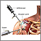 Shoulder arthroscopy Shoulder arthroscopy