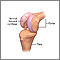 Partial knee replacement - series Partial knee replacement - series