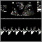 Ultrasound, normal fetus - heartbeat Ultrasound, normal fetus - heartbeat