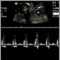 Ultrasound, ventricular septal defect - heartbeat Ultrasound, ventricular septal defect - heartbeat