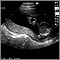 Ultrasound, normal relaxed placenta Ultrasound, normal relaxed placenta