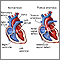 Truncus arteriosus Truncus arteriosus