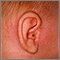 Mastoiditis - side view of head Mastoiditis - side view of head