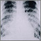 Chickenpox, acute pneumonia - chest X-ray Chickenpox, acute pneumonia - chest X-ray