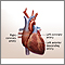 Heart bypass surgery - series Heart bypass surgery - series