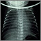 Totally anomalous pulmonary venous return - X-ray Totally anomalous pulmonary venous return - X-ray